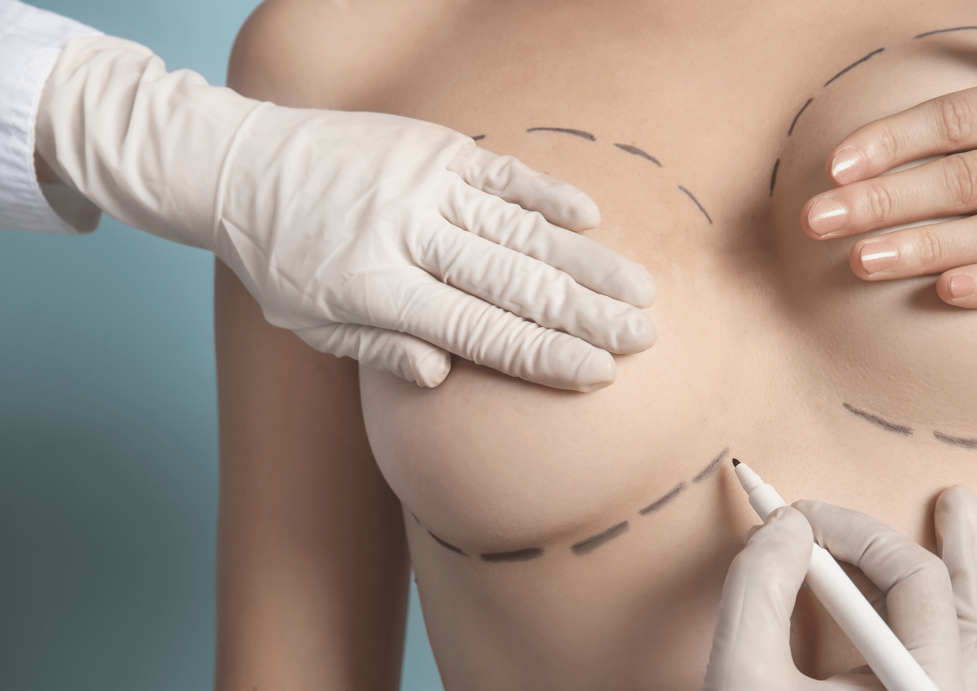 Breastfeeding after breast augmentation surgery, Cosmetic Journey